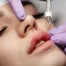 Aumento de labios ácido hialurónico en Murcia