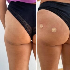 Antes Y Después Aumento De Glúteos Con Hialurórico