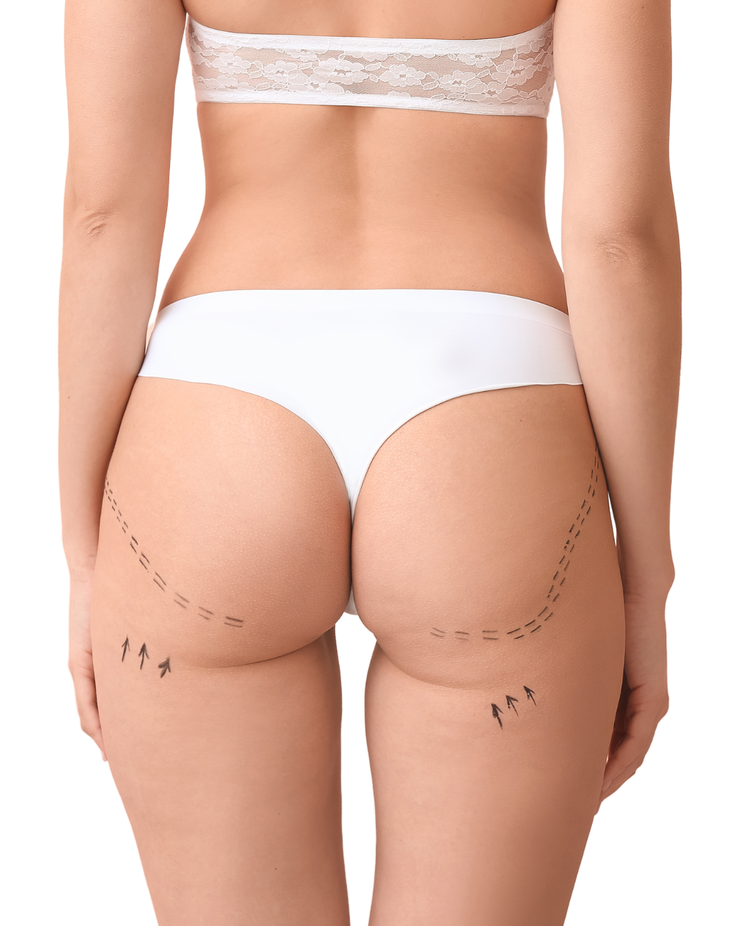 Aumento de glúteos sin cirugía Murcia