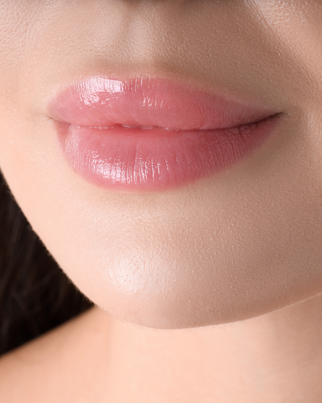 Aumento de labios con ácido hialurónico en Murcia Resultado natural de aumento de labios con ácido hialurónico en Ananda Centro Médico Estético Murcia