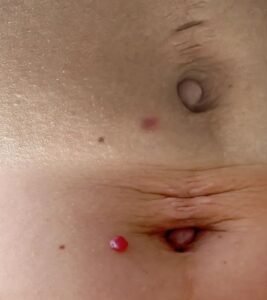 Resultado antes y después de eliminar un angioma o punto rubí con láser en Murcia