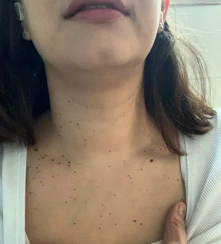 Acrocordones Antes Murcia.jpg Acrocordones en el cuello antes del tratamiento en Murcia
