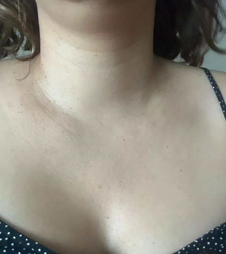 Acrocordones Despues Murcia.jpg Cuello sin acrocordones después del tratamiento con láser en Murcia